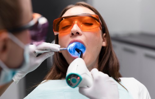 Composite Fillings